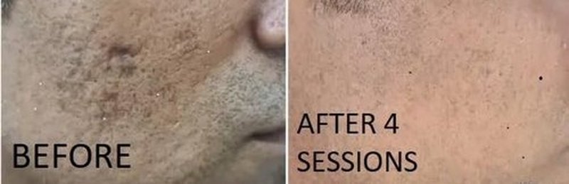 TC A 100% Peel - Medium Depth Chemical Peel for Scars | 0.3oz (10ml) - Ideal for Aestheticians & DIY Skincare