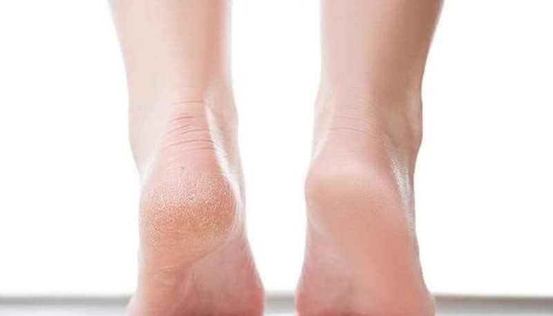 Ever Ready Corn & Callus Trimmer - Instant Relief from Corns & Calluses | Removes Dry, Hard & Cracked Skin | Home Pedicure Treatment for Footcare