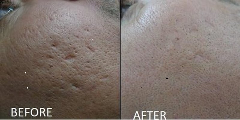 TC A 100% Peel - Medium Depth Chemical Peel for Scars | 0.3oz (10ml) - Ideal for Aestheticians & DIY Skincare