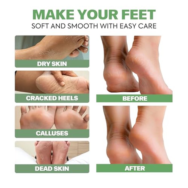veletine Tea Tree & Aloe Foot Care Set - Urea Cream,Callus Remover Gel & Foot Callus Remover,10Pairs Mask Sleeves for Dry Cracked Feet - Pedicure Kit for for Birthday Valentine's Women Men Gift