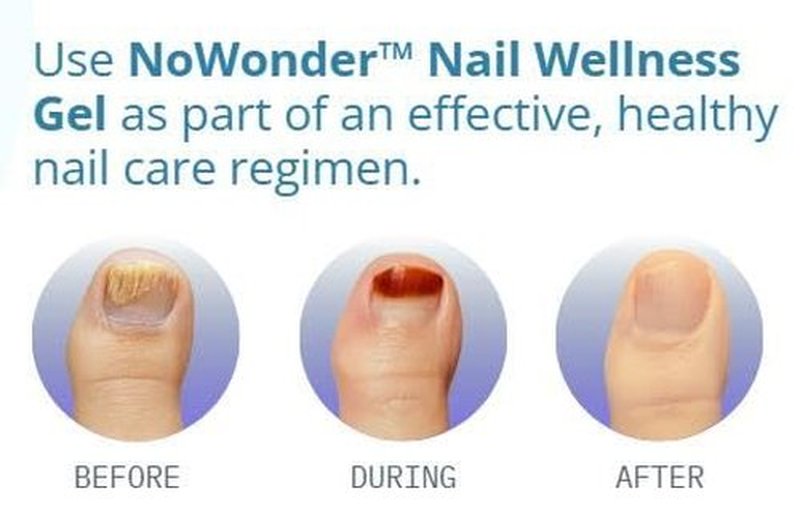 NoWonder Nail Wellness Gel - Nitric Oxide Nail Renewal Solution for Healthier, Clearer Nails | Easy-to-Use