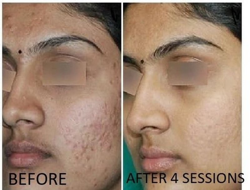 TC A 100% Peel - Medium Depth Chemical Peel for Scars | 0.3oz (10ml) - Ideal for Aestheticians & DIY Skincare