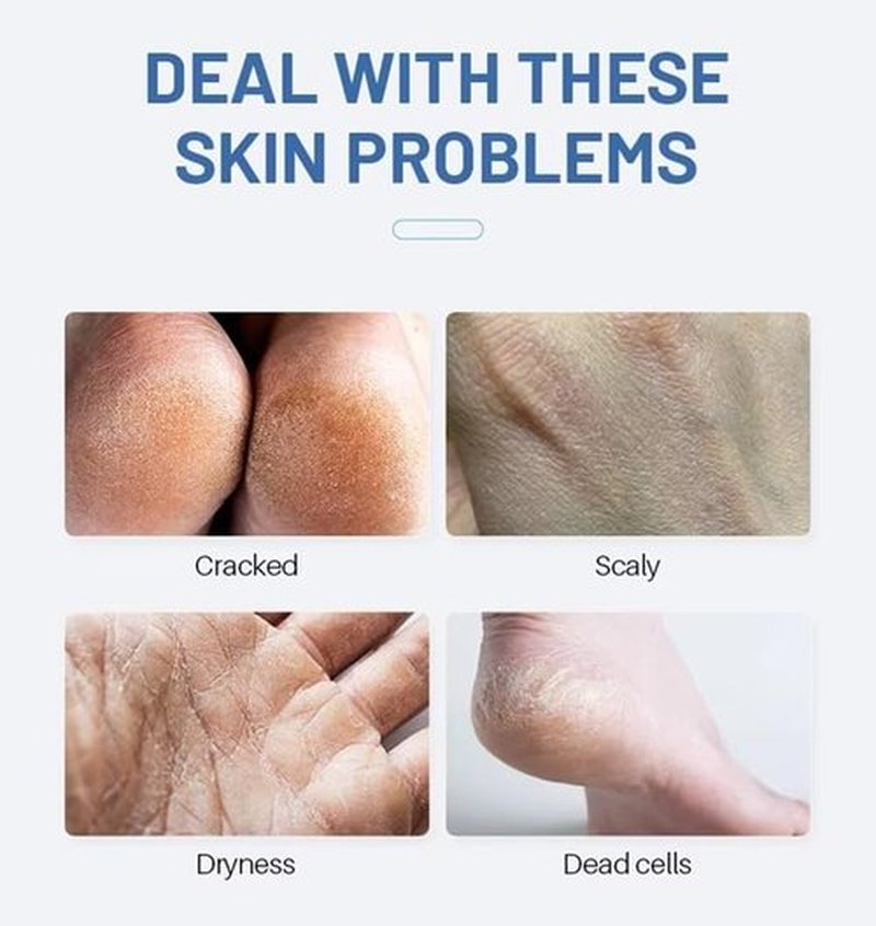 Advanced Urea Foot Cream 40% plus 2% Salicylic Acid for Cracked Heels and Dry Skin, 150gms/5.3oz with Tea Tree, Coconut Oil and Aloe Vera Extract for Deep Moisturizing Callus Removal