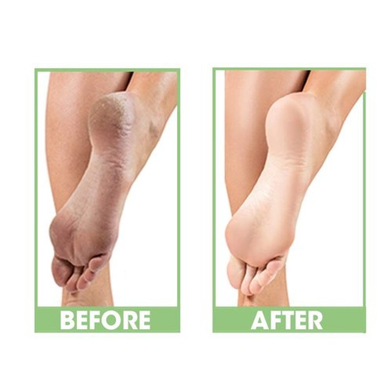 ProLinc Dry Heel Eliminator - Hydrate & Protect Dry Heels | Fast Absorbing, Non-Greasy Formula | 4 Fl. Oz