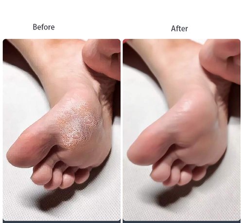 4 Pieces Double Sided Foot File Callus Remover Foot Sander Foot Scrubber Dead Skin Remover Pedicure Tools
