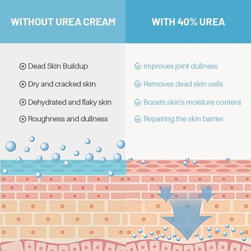 Advanced Urea Foot Cream 40% plus 2% Salicylic Acid for Cracked Heels and Dry Skin, 150gms/5.3oz with Tea Tree, Coconut Oil and Aloe Vera Extract for Deep Moisturizing Callus Removal
