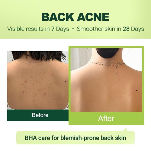 pure.tiful 2% Salicylic Acid (BHA) Serum for Acne & Blackheads - Unclogs Pores, Oil Control, Sensitive-Skin Safe, Fragrance-Free,1 fl.oz