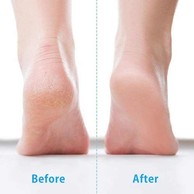 Skiennix Foot File - Stainless Steel Callus Remover for Professional Pedicure | Wet & Dry Use