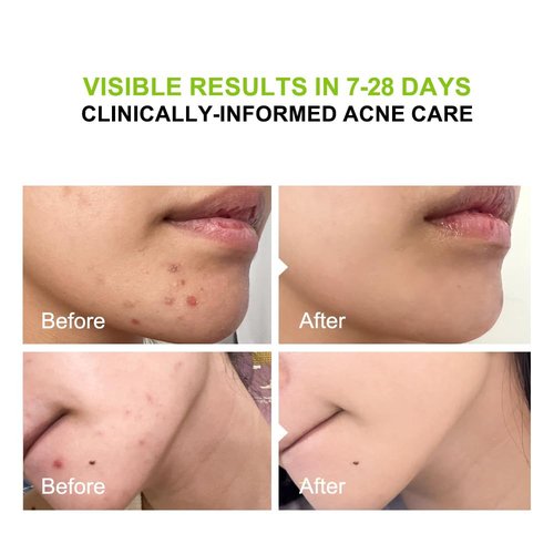 pure.tiful 2% Salicylic Acid (BHA) Serum for Acne & Blackheads - Unclogs Pores, Oil Control, Sensitive-Skin Safe, Fragrance-Free,1 fl.oz