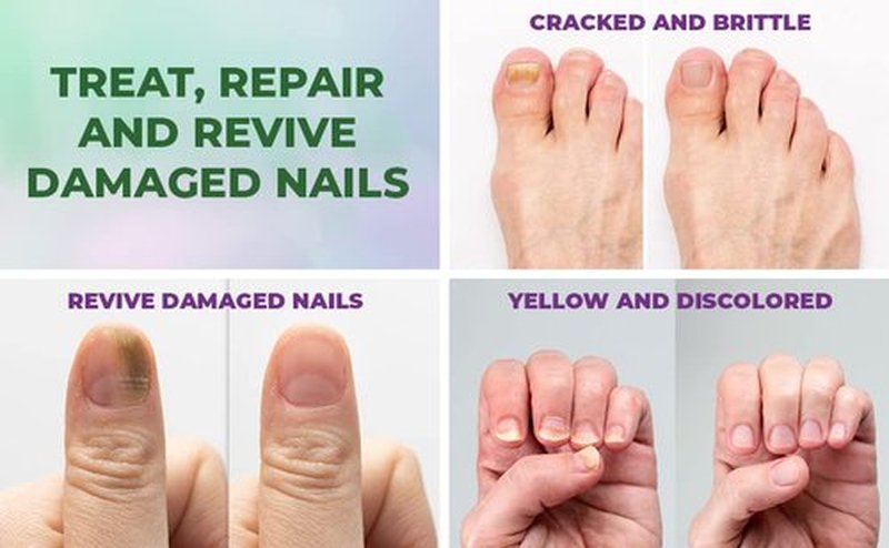 Perfecto Toenail Treatment with Tea Tree Oil - Fingernail and Toe Nail Treatment Extra Strength - Nail Repair Foot Nail Treatment - Renews Foot, Yellow & Cracked Nails