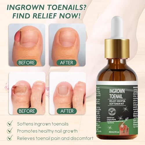 Ingrown Toenail Treatment - 30ml Softening & Conditioning Kit for Easy Trimming with Silicone Gel Toe Caps - Comprehensive Ingrown Toenail Removal Sol