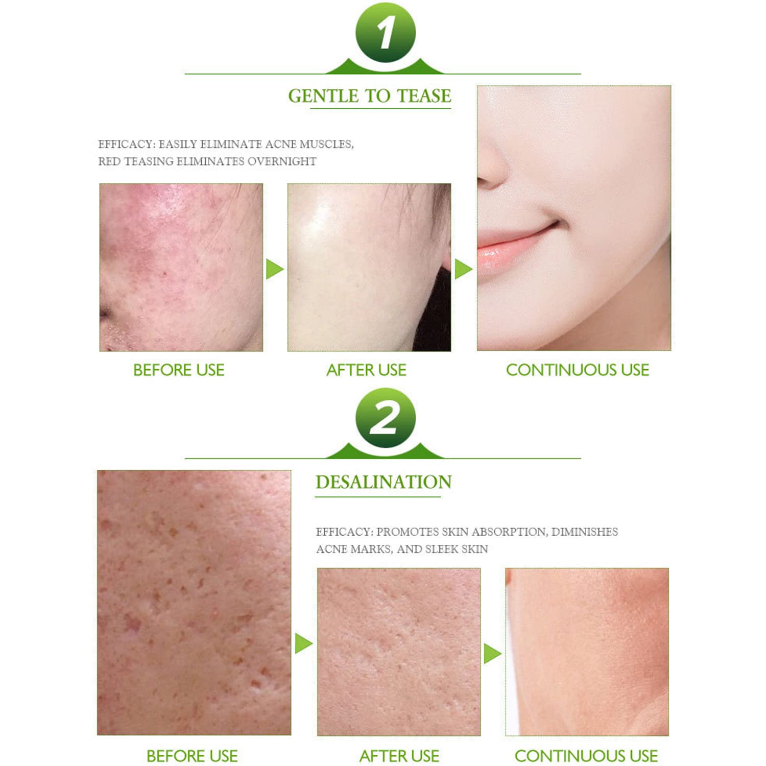 AICHUN BEAUTY Face Acne Cleaning Cream Skin Care Remove Repair Comedone Pimple Acne Face Acne Cream 30ml/1.0fl.oz