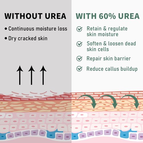60% Urea Cream Maximum Strength, 10.1 oz - Foot & Hand Cream for Dry Cracked Skin, Callus Remover, with 2% Salicylic Acid - Deep Moisturizer for Cracked Heels, Rough Elbows & Knees - Fast Absorbing