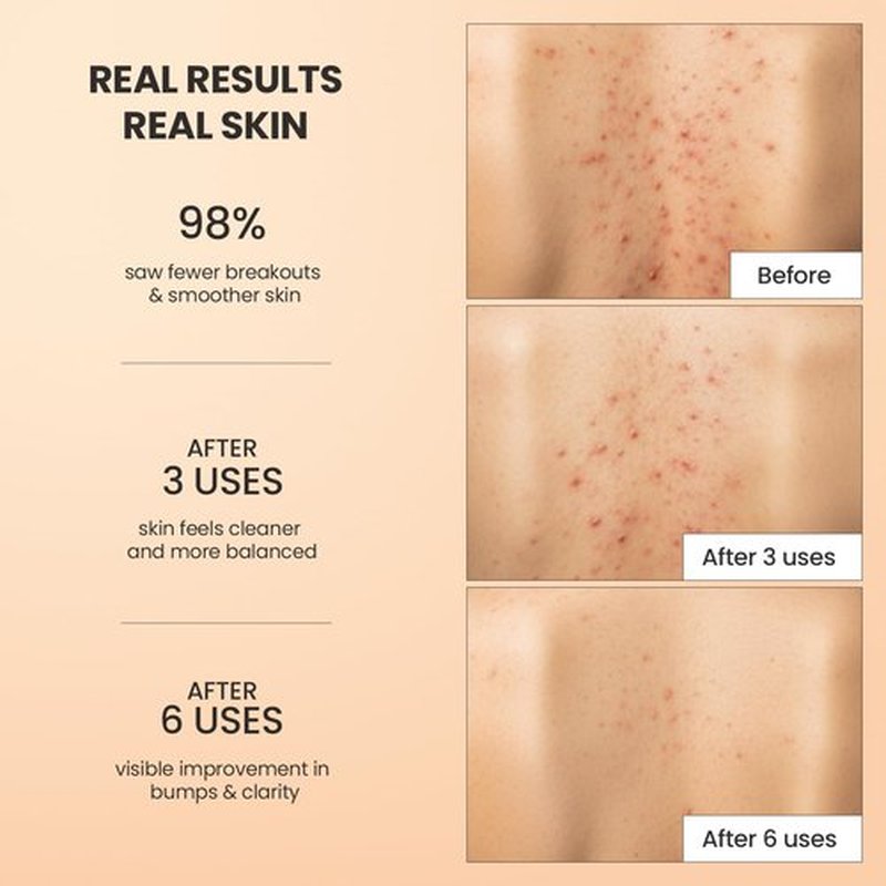 BellamiLuxx Body Acne Treatment Scrub: Helps Reduce Body Breakouts on Back, Chest, Butt & Thighs - Back Acne Treatment for Men, Women & Teens - Butt Acne Wash with Natural Actives for Smooth Skin