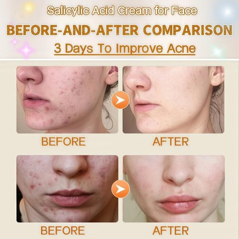 Skiennix Salicylic Acid Acne Treatment Face Cream - Oil Control & Pore Refining, Non-Comedogenic, 50ml / 1.69oz (2)