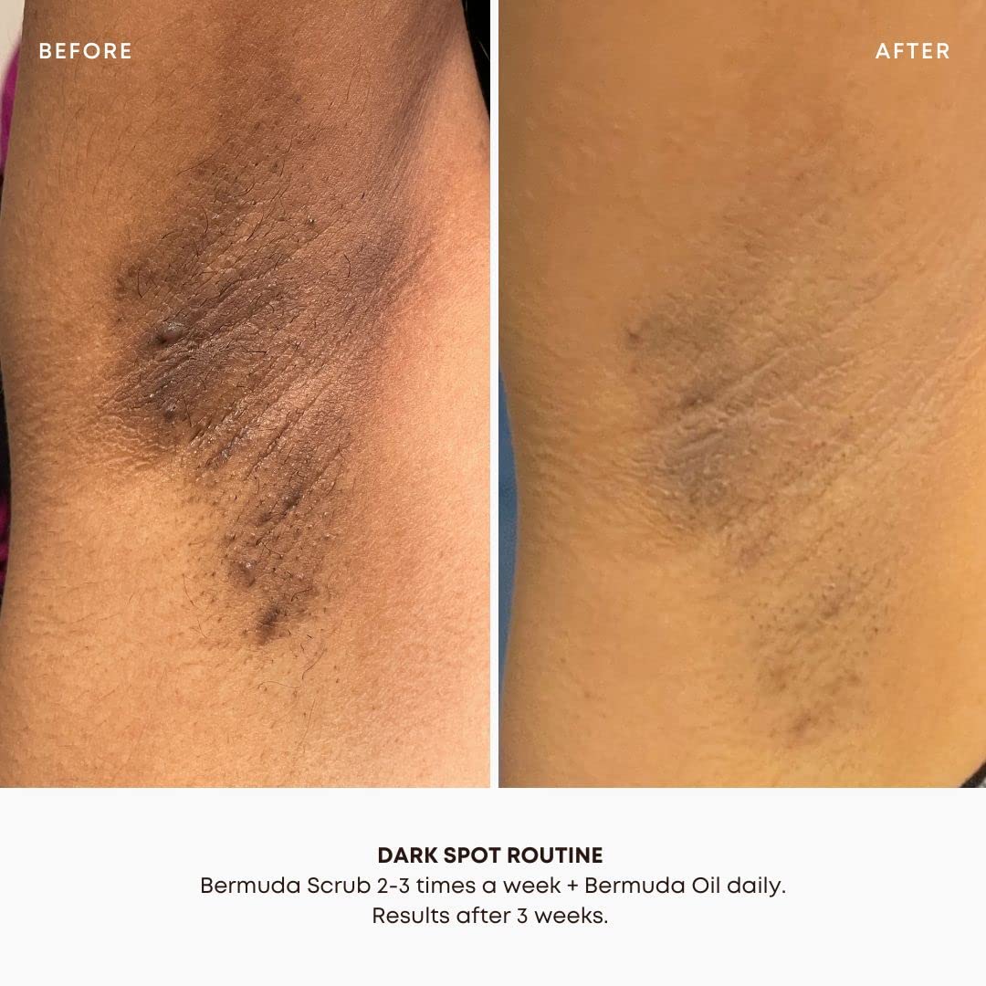 Bushbalm Dark Spots and Ingrown Hair 2 Step Routine - Rejuvenate and Nourish - Ingrown Hair Oil (30 ml) and Exfoliating Scrub (236 ml) - Bermuda - Valued at $49