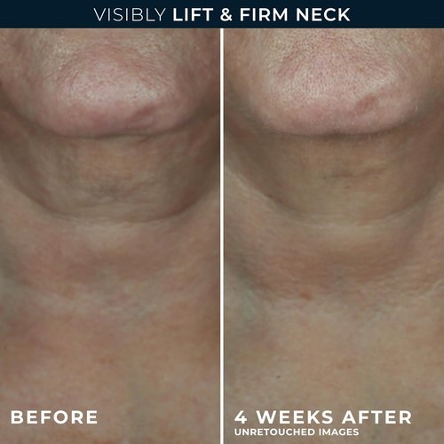 RoC Derm Correxion Neck Cream - Hyaluronic Acid & Advanced Retinol for Tightening & Lifting (1.7 oz)