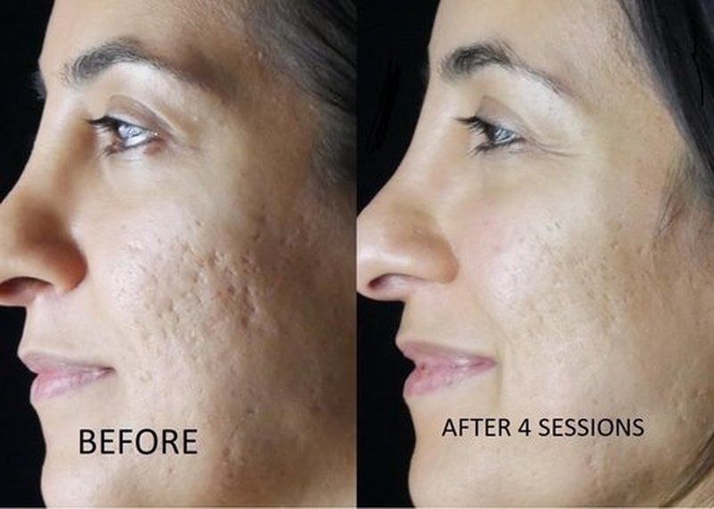 TC A 100% Peel - Medium Depth Chemical Peel for Scars | 0.3oz (10ml) - Ideal for Aestheticians & DIY Skincare