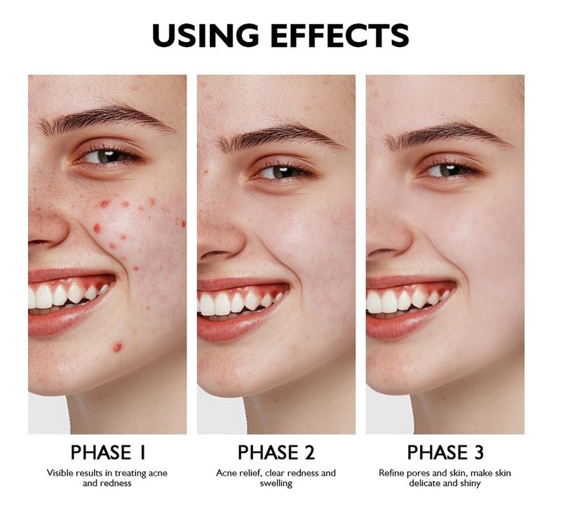 Azelaic Acid Serum by Regine Switzerland - Acne Treatment & Pore Refining Cream | 30ml for Sensitive Skin
