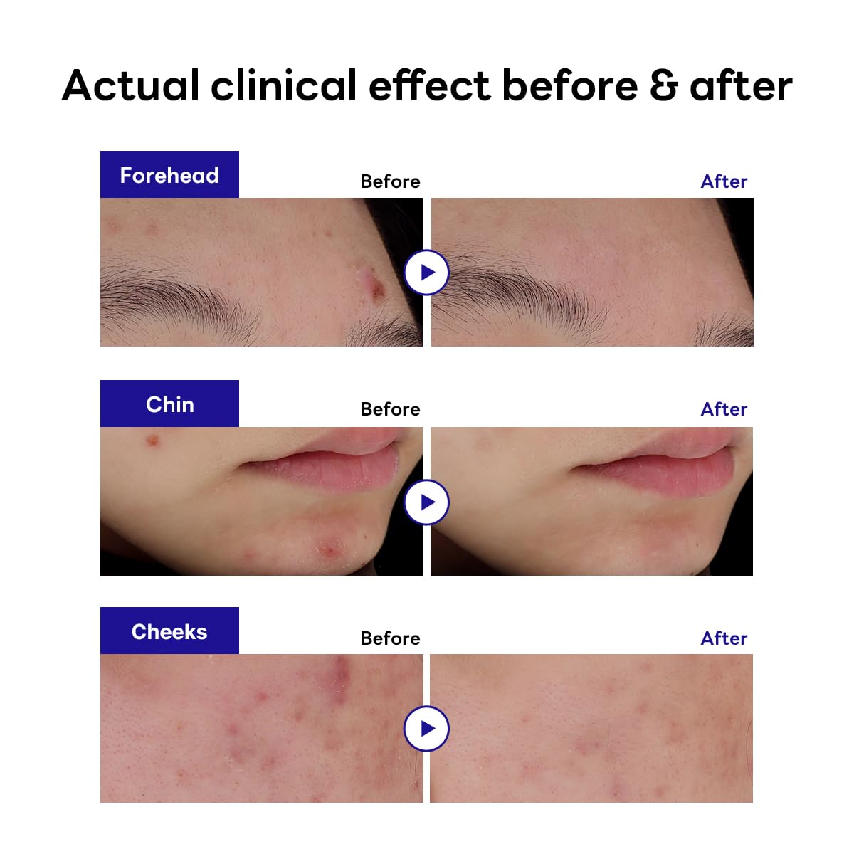 MEDIHEAL Derma Clear Madecassoside Blemish Spot Patch (132 Counts) - Acne Spot Protection, Spot Fast Healing with Madecassoside & Niacinamide