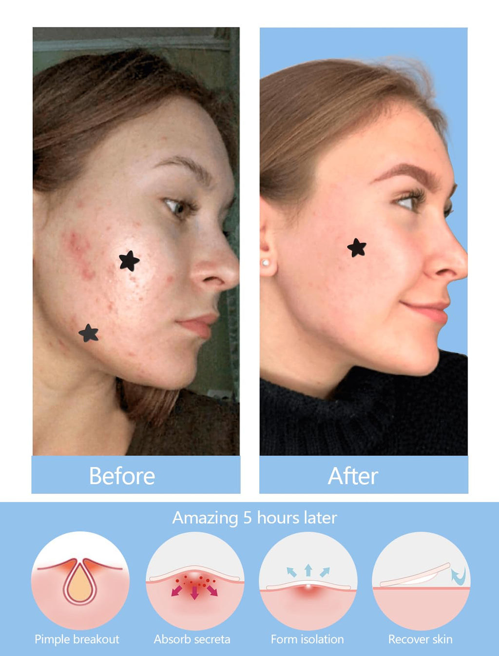 ZHAOLIESM Black Star Pimple Patches for Face, 153 Counts Hydrocolloid Star Acne Patches, Cute Zit Covers for Face, Spot Stickers with Tea Tree, Salicylic Acid and Cica Oil