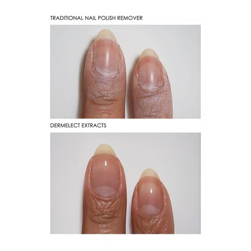 Dermelect Clean & Care Nail Renewal Kit – Nailcare Treatment Set with Ridge Filler, Nail Brightener & Polish Remover Wipes – Strengthens, Brightens & Restores Damaged, Discolored, Weak Nails