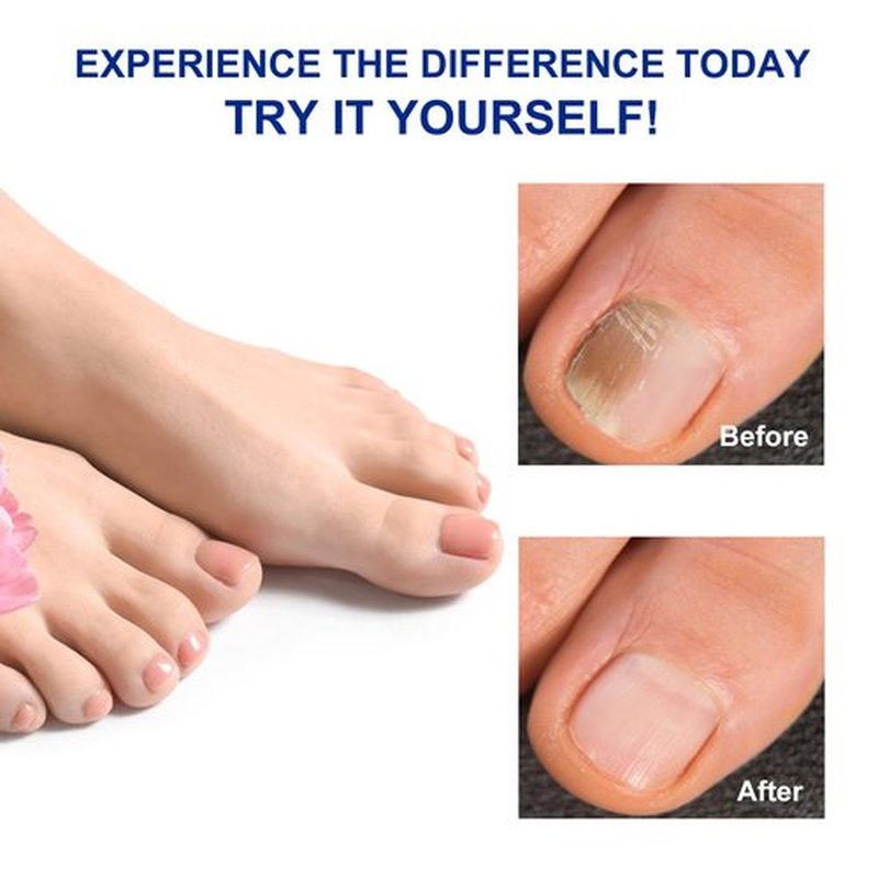 Toenail Treatment Extra Strength-8-Hrs Overnight Nail Repair,ingrown toenail treatment,Strengthens Brittle Nails,Improves Texture & Thickening Hypoallergenic Easy (64 Patch)