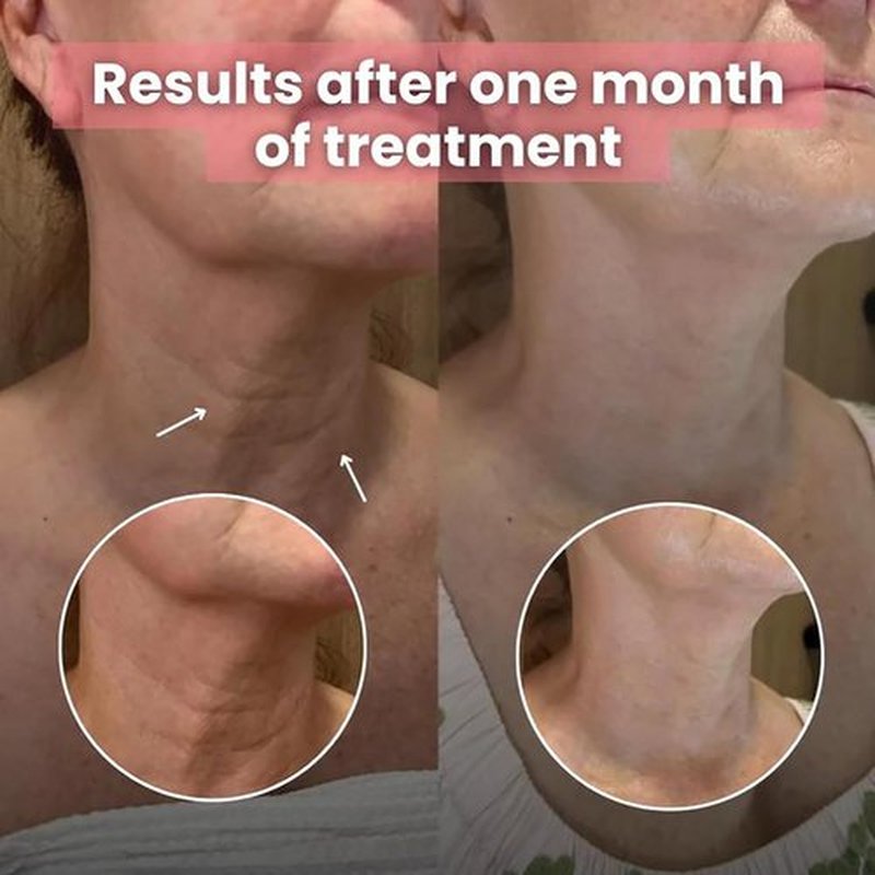 Skiennix Bio-Collagen Necklift Mask - Achieve a Youthful Neck in Just 1 Use | Hydrating & Firming Silicone Patches (2)
