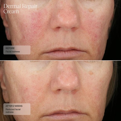 Senté Dermal Repair Facial Cream - Nourishing Formula for Rosacea & Sensitive Skin | Hydrate & Soothe | 1.7 Fl Oz