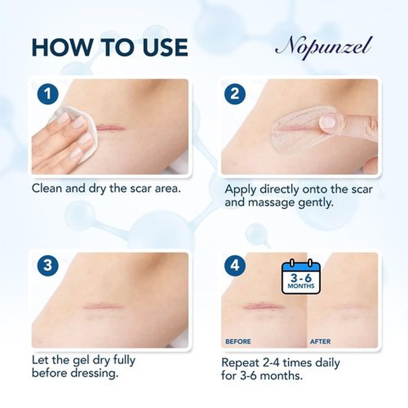 Silicone Scar Gel: Silicone Gel for Scars - Improve Scar Appearance for Old and New Scars - Medical Grade Silicone - Advanced Scar Gel - Scalds - Surgery - Injury - Stitches - Burns - 20g
