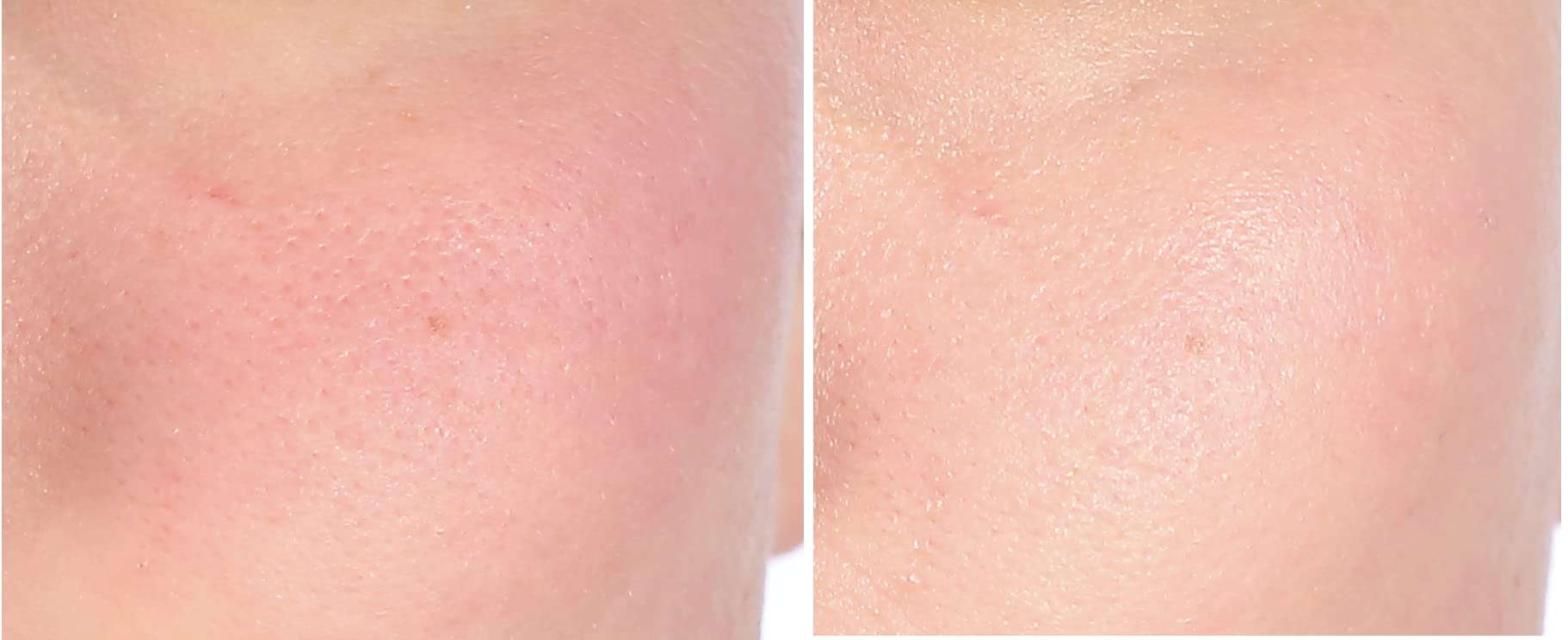 Nakery Intensive Repair Treatment Eczema Relief Soothing Cream for Face & Body | 2% Colloidal Oatmeal | Immediate Relief