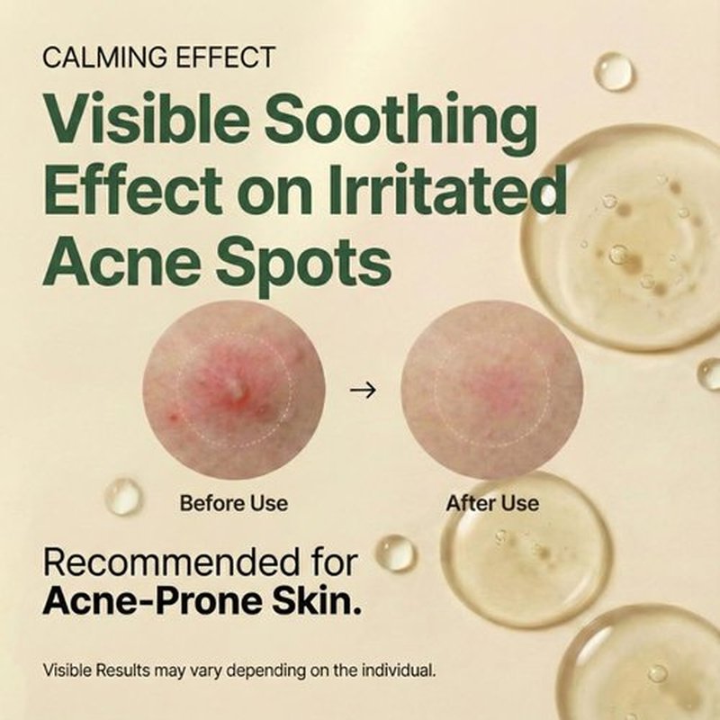 Centella | Soothing Serum with 494,700 ppm Centella Asiatica - Acne Relief for Sensitive Skin, 30ml