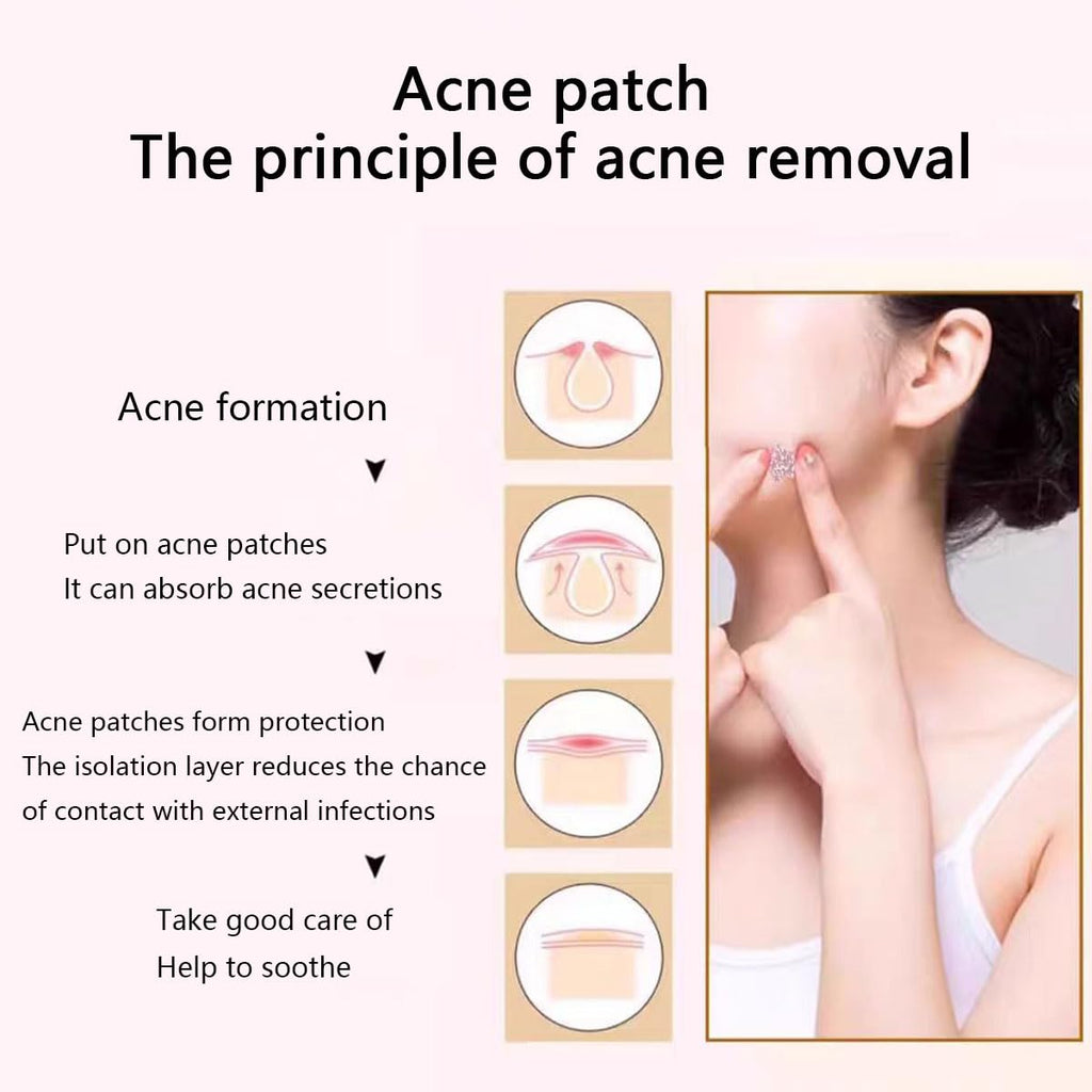 VibeSeal pimple patches 240pc Hydrocolloid Acne Spot Treatment Patch for Early Stage Zits and Hidden Pimples