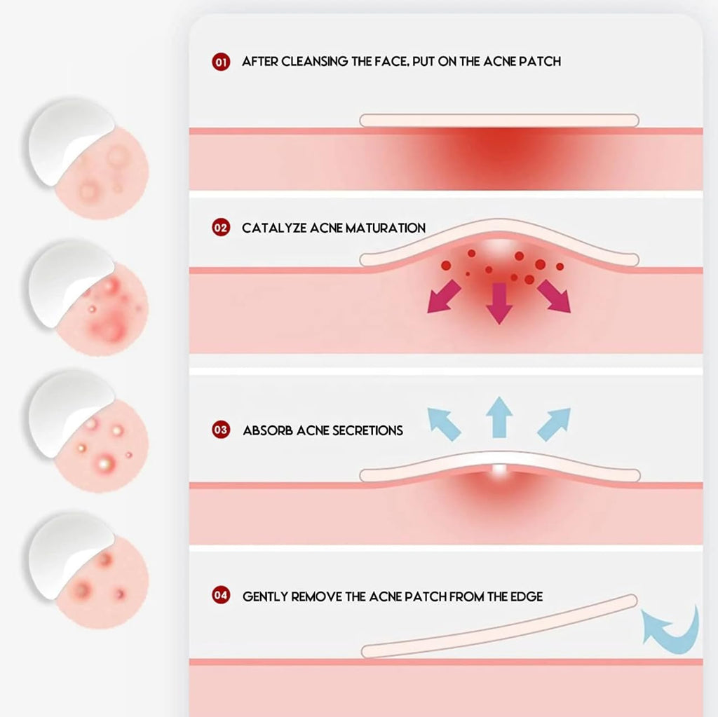 kisskin ZitZap Pimple/Acne Patches For Face And Skin, Hydrocolloid Patches With Salicylic Acid And Tea Tree Oil For Covering Zits And Blemishes.