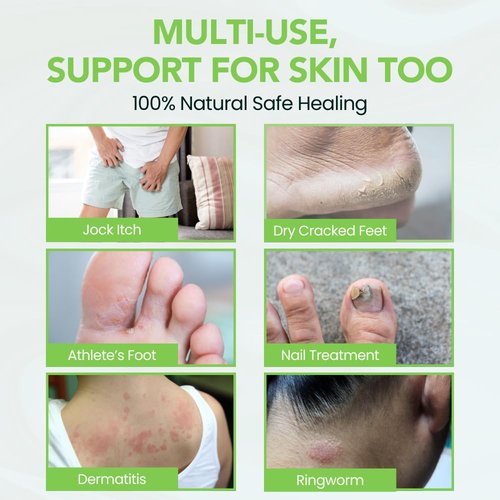 Thena Athletes Foot Cream Extra Strength Herbal Relief with Tea Tree Neem & Menthol, Athletes Foot Treatment Balm for Itchy Dry Cracked Feet, Heels and Toes, Advanced Plant-Based Foot Care