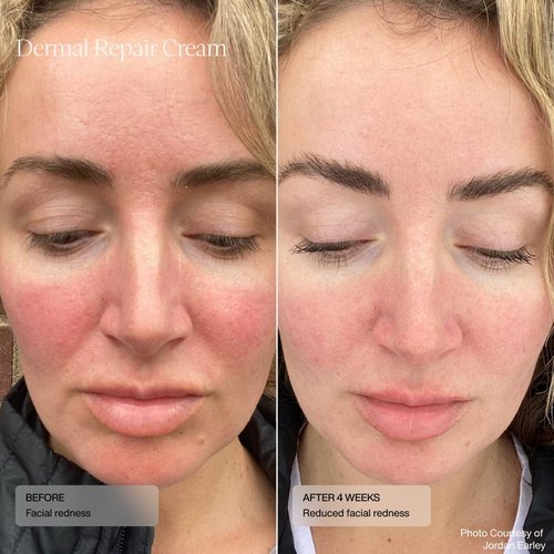 Senté Dermal Repair Facial Cream - Nourishing Formula for Rosacea & Sensitive Skin | Hydrate & Soothe | 1.7 Fl Oz
