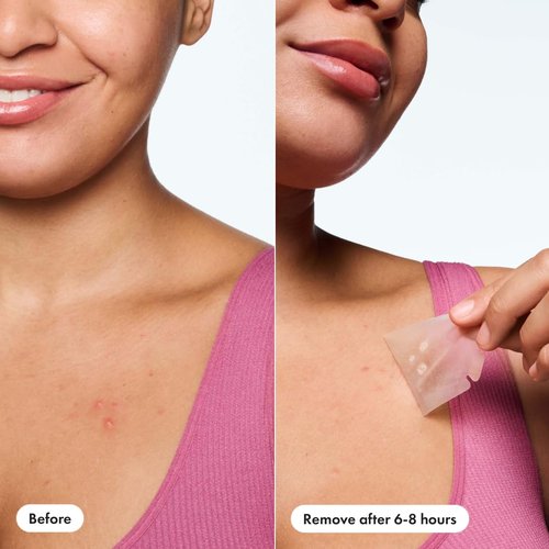 Mighty Patch Hero Cosmetics Body Patch– The XXL Hydrocolloid Patch for Bacne, Chestne, and Other Body Breakouts. Derm-Tested. Medical-Grade Hydrocolloid. Absorbs Pimple Gunk in 6-8 Hours. 4ct
