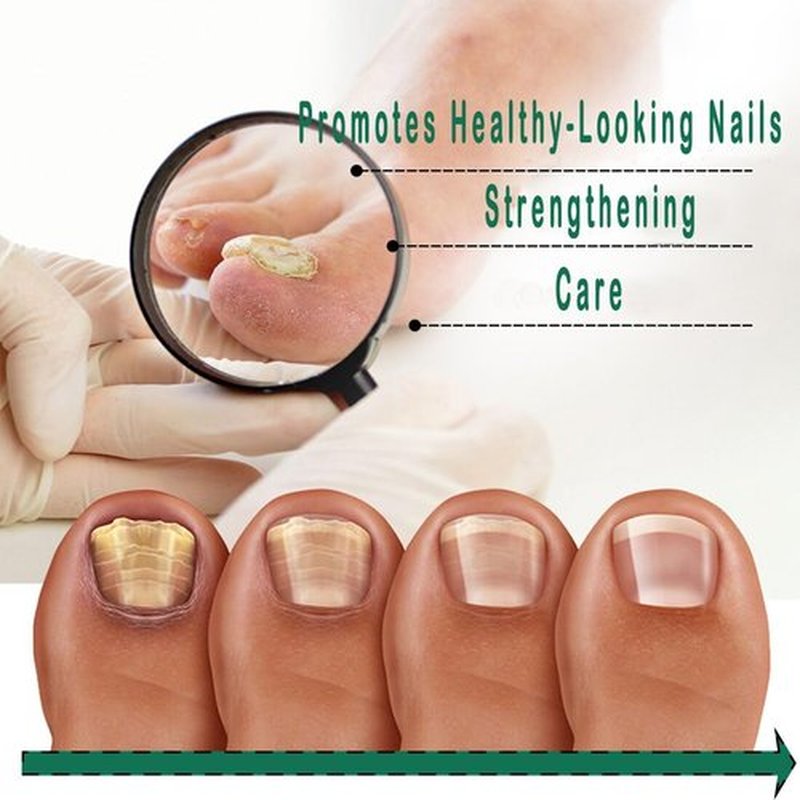 Nail Treatment Gel - 2 PCS Nail Growth Repair Cream for Fingernails and Toenails, Fix & Renew Damage Fungal Nail, Broken, Cracked & Discolored Nails