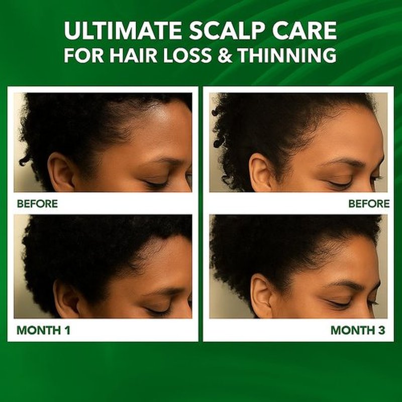 Scalp Oil for Hair Loss & Thinning Hair: Stimulates Follicles and Nourishes Scalp with Batana, Rosemary & Tea Tree – Ideal for Coily, Curly, Dry & Damaged Hair – Soothes Dry, Itchy, Flaky Scalp (60mL)