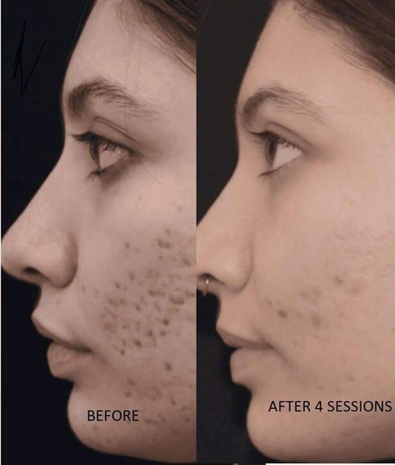 TC A 100% Peel - Medium Depth Chemical Peel for Scars | 0.3oz (10ml) - Ideal for Aestheticians & DIY Skincare