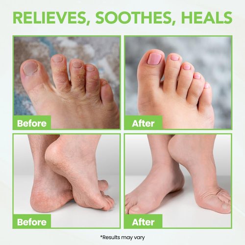 Thena Athletes Foot Cream Extra Strength Herbal Relief with Tea Tree Neem & Menthol, Athletes Foot Treatment Balm for Itchy Dry Cracked Feet, Heels and Toes, Advanced Plant-Based Foot Care