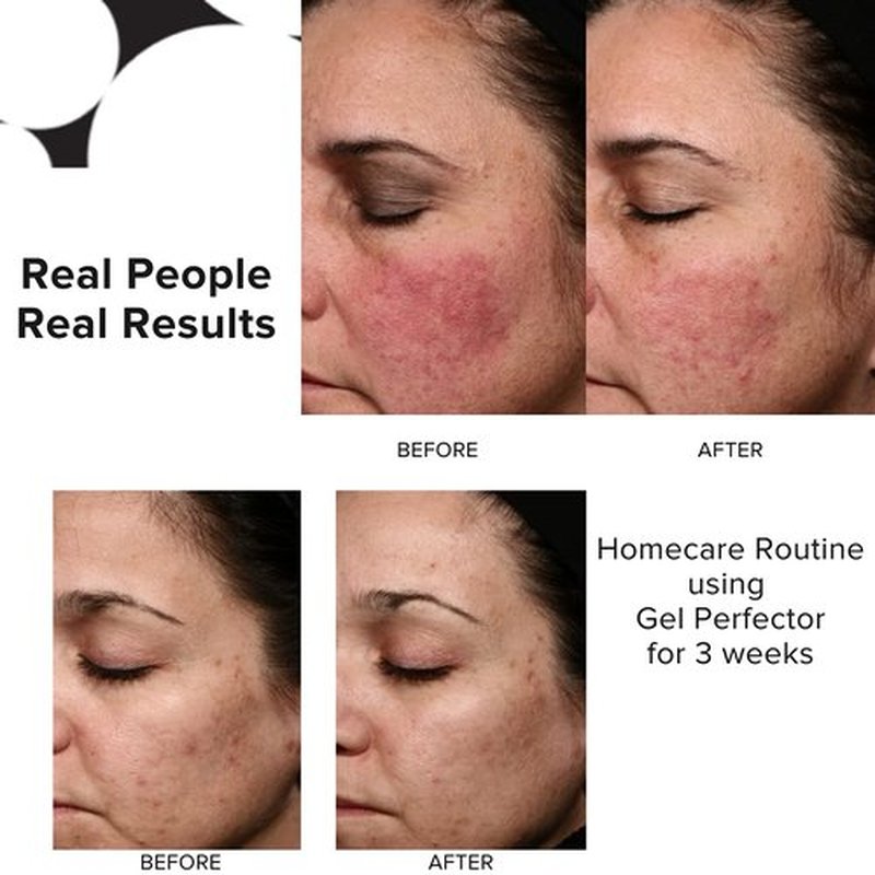 PRIORI Skincare Gel Perfector - Acne Treatment for Oily Skin & Blemishes | 1 fl oz, Fragrance-Free
