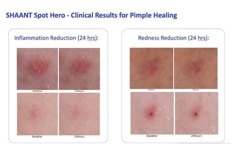 Codex Labs Shaant Spot Hero - 5% Sulfur Acne Treatment for Sensitive Skin | Shrinks Breakouts | 0.5 oz