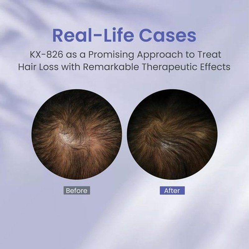 KINTOR Hair Regrowth Spray - 0.9% KX-826 Formula for Healthy Hair Growth | Oil Control, 60ml