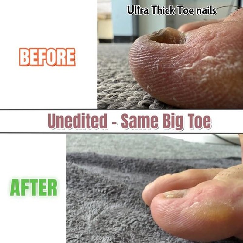 IDOU 4-in-1 Toe Nail Care Kit: Toe Nail Files for Thick Nails with Ingrown Toenail Lifter & Silicone Thumb Guard | Non-Slip Grip, 2 Metal Nail Files for Men/Seniors/Silver Lifter