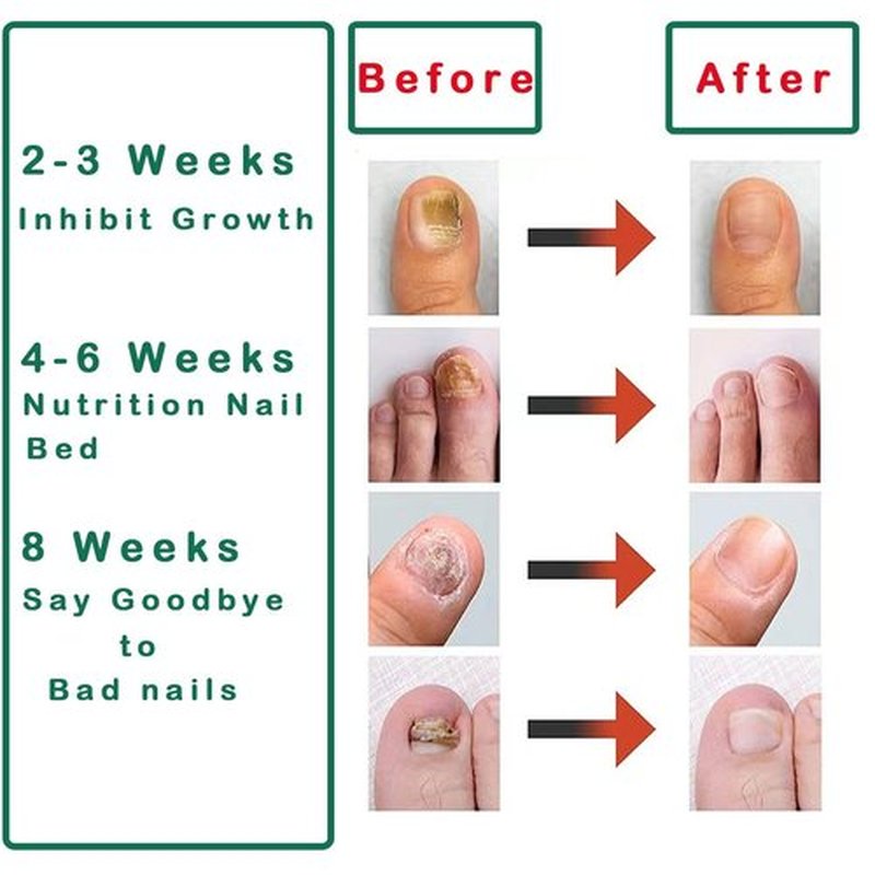 Nail Treatment Gel - 2 PCS Nail Growth Repair Cream for Fingernails and Toenails, Fix & Renew Damage Fungal Nail, Broken, Cracked & Discolored Nails