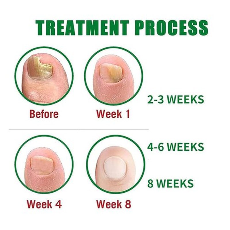 Nutraboost Nail Treatment Gel, Nail Growth Serum for Repair & Strengthener, Multi-Purpose Nail Repair Oil Serum, Foot Care Cream(1pcs)