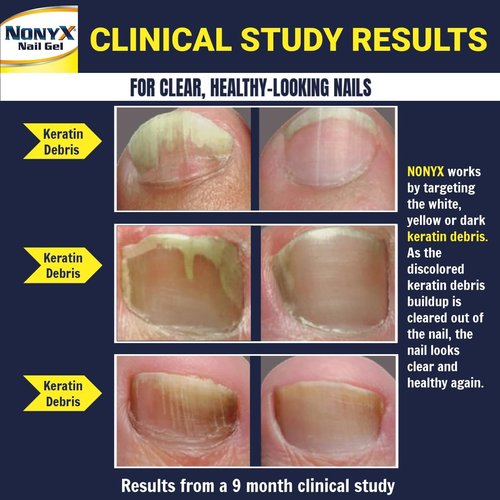 NONYX Fungal Nail Clarifying Gel - Clinically Proven Treatment for Discolored & Brittle Toenails | 90% Improvement Rate
