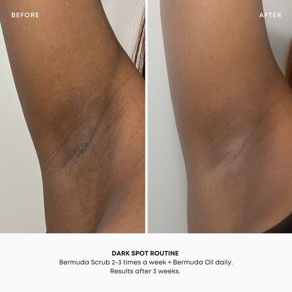 Bushbalm Dark Spots and Ingrown Hair 2 Step Routine - Rejuvenate and Nourish - Ingrown Hair Oil (30 ml) and Exfoliating Scrub (236 ml) - Bermuda - Valued at $49