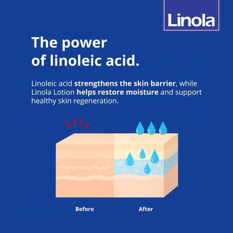 Linola Forte Lotion - Body Lotion with Essential Linoleic Acids - Nourishing Cream against Itching with 24-Hour Effect - Soothes Itchy, Dry & Irritated Skin - Made in Germany - 200 ml (6.8 Fl Oz)